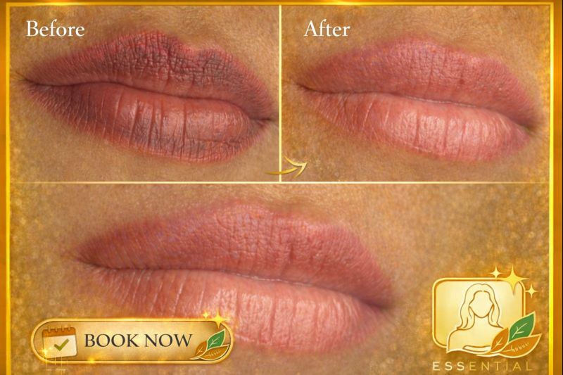 Lip Tattoo Removal Results