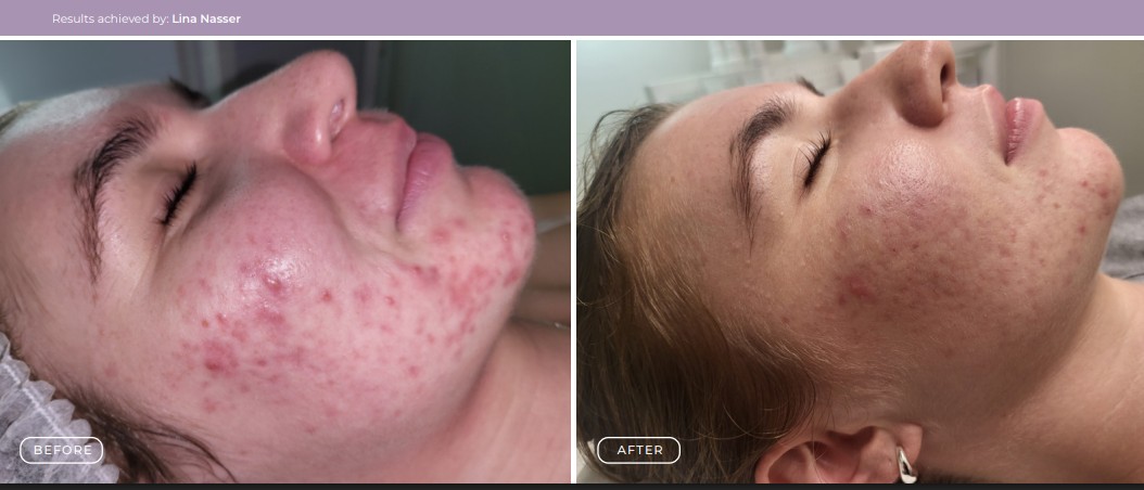 Circadia Acne Treatment Results