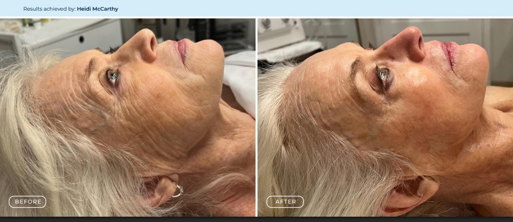 Circadia Anti-Aging Results