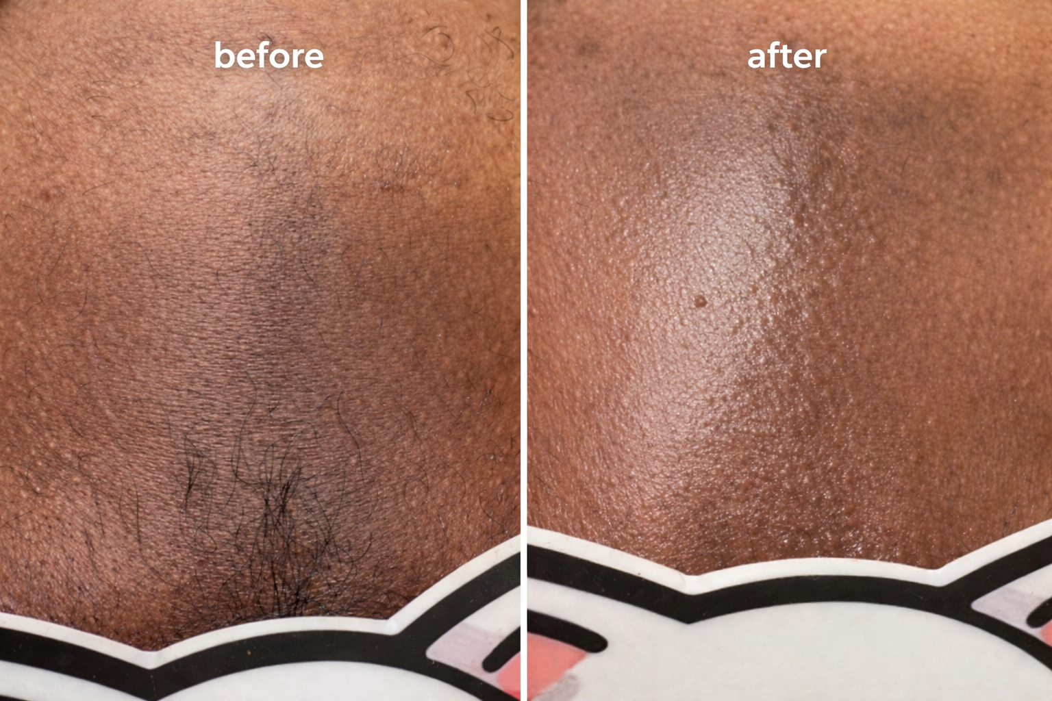 Sugaring Bikini Results