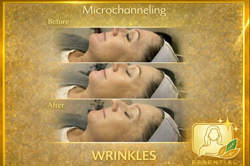 Microchanneling Fine Lines Results