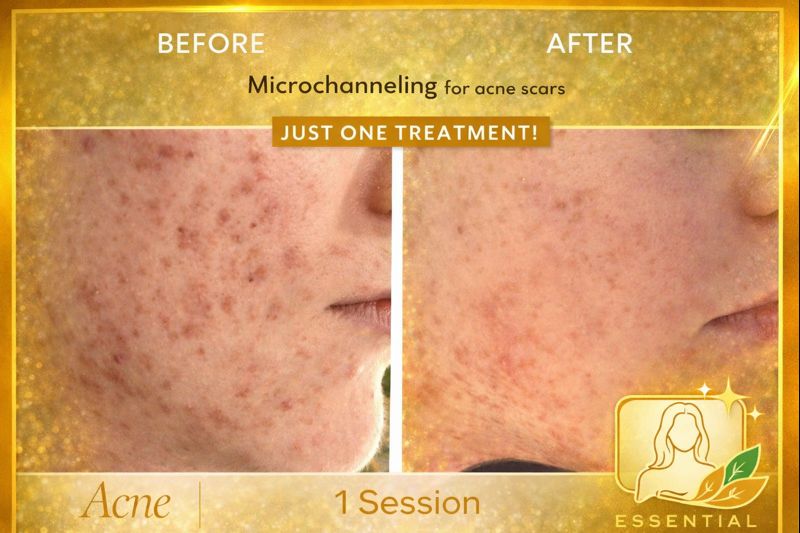 Microchanneling Acne Results